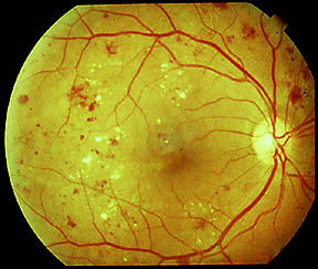 Image showing features of diabetic retinopathy